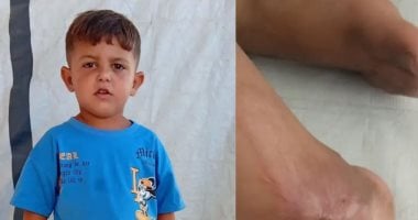 الطفل يازن علوان في غزة ينتظر إخلاءً طبياً عاجلاً بينما تناشد أسرته الهيئات الدولية